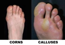 (5)Tips how to treat your corns and calluses.