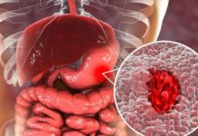 HANYOYIN DA ZAMUBI WAJEN KARE KAI DAGA CIWON GYAMBON CIKI WATO ULCER.