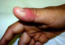 Yadda ake magance Dan karkare a gida(whitlow)