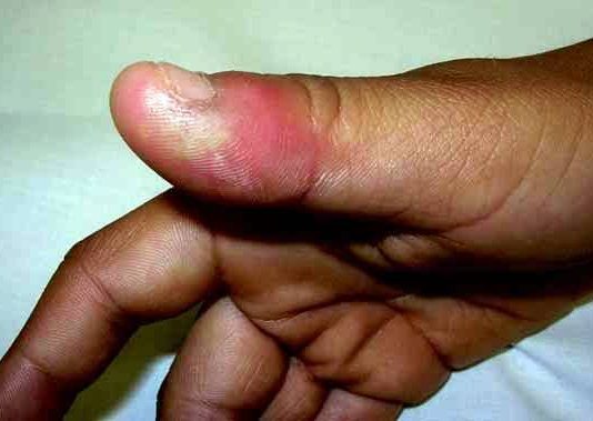 Yadda ake magance Dan karkare a gida(whitlow)