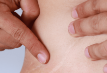 Yadda zamu cire zanen jiki (stretch marks)