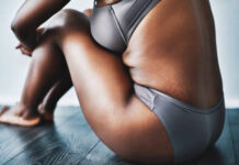 How To Remove Stretch Marks